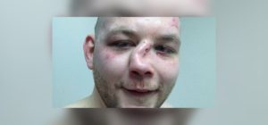 В драке сломали нос что делать
